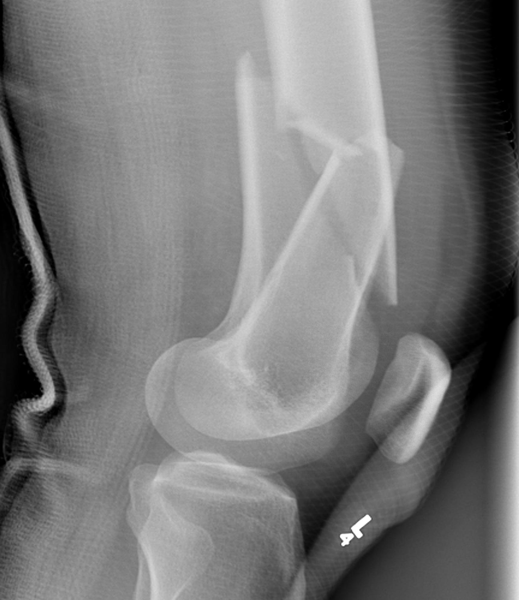 Intercondylar fracture